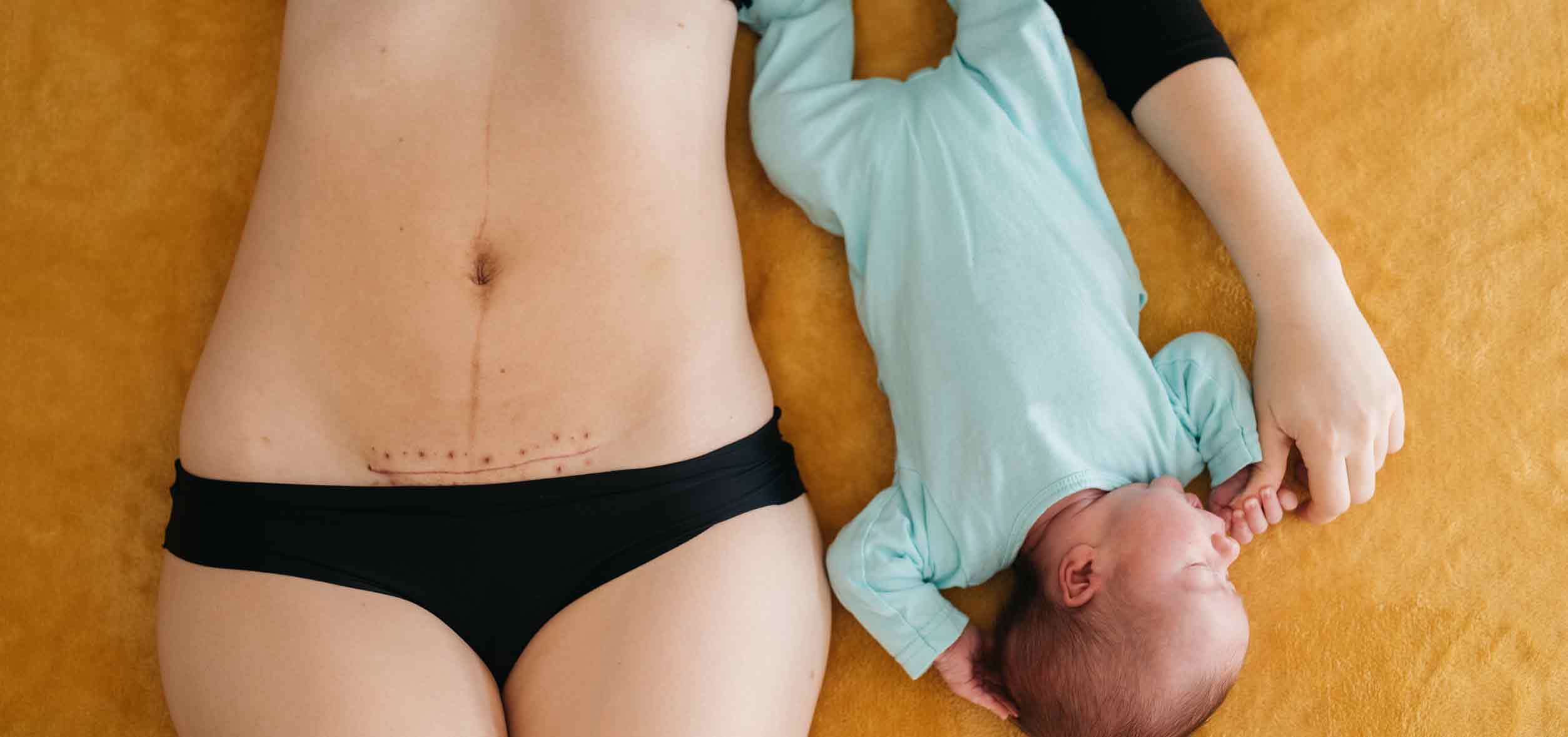 Recovering from your C-section