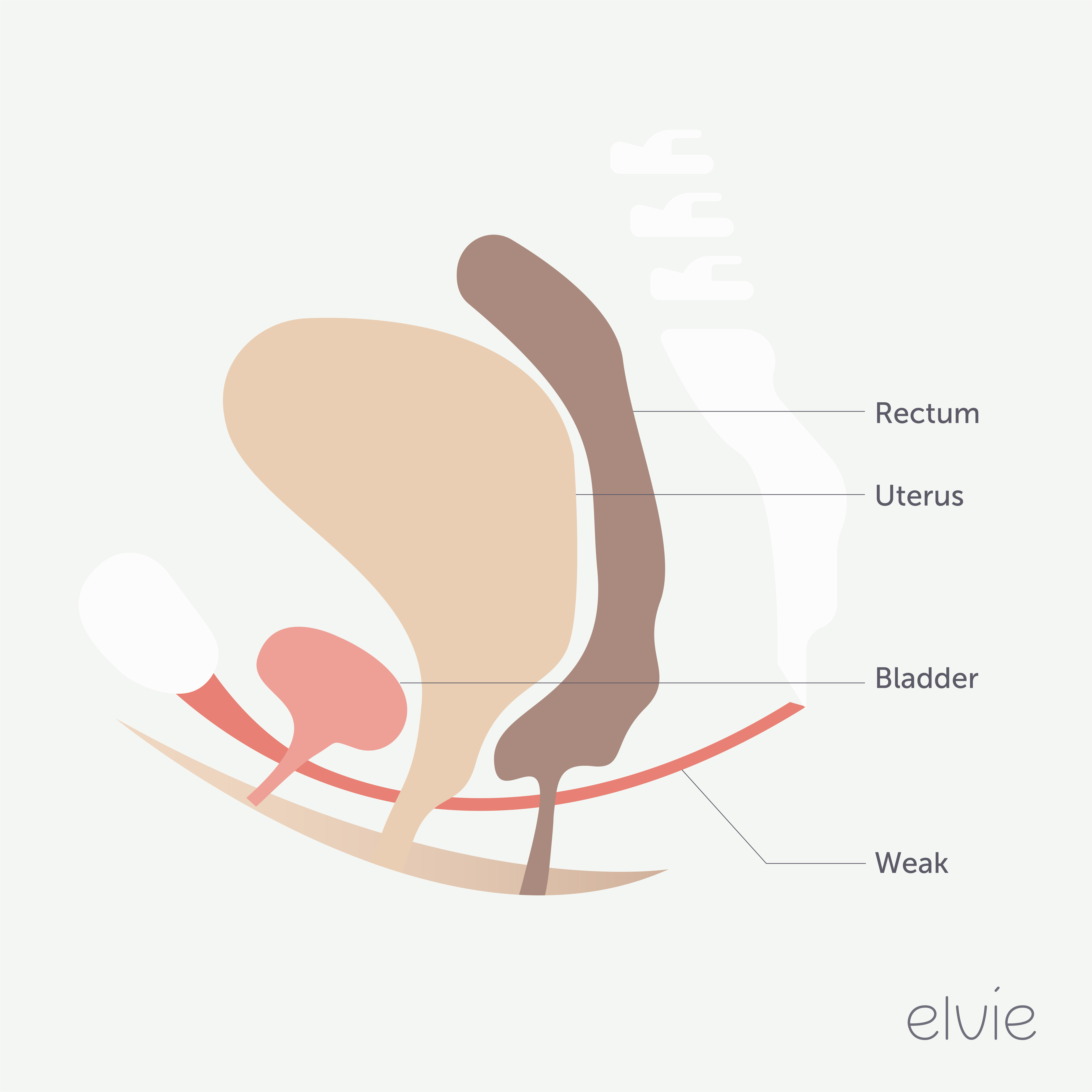 Bladder leakage happens when the pelvic floor is weak.