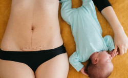 Recovering from your C-section